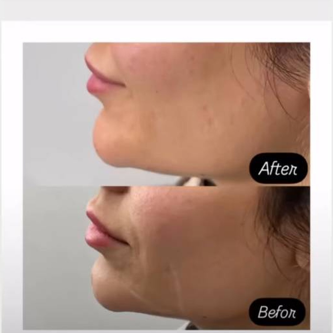 نمونه کار اصلاح فرم چانه