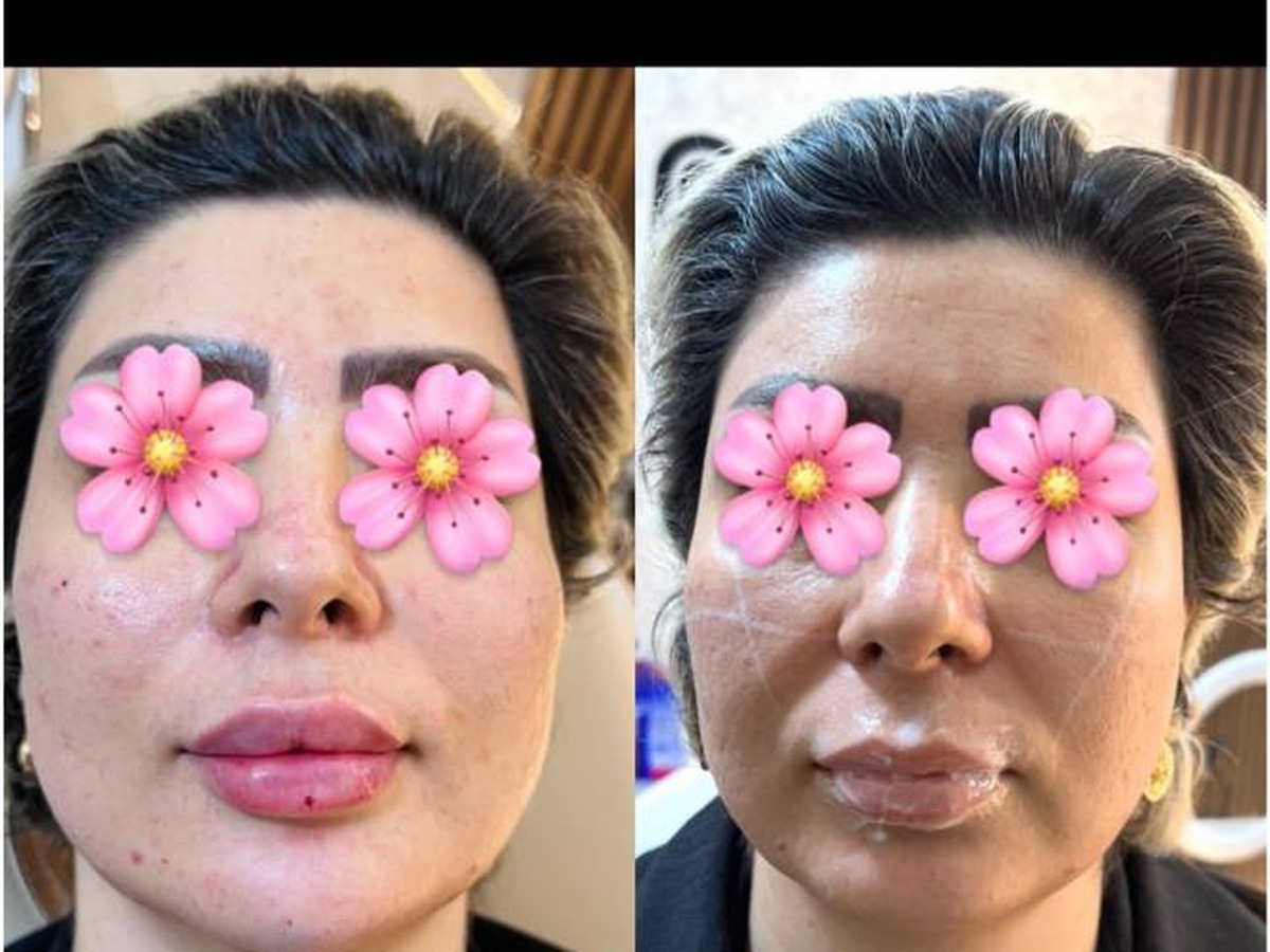 نمونه کار لیفت و اصلاح فرم چهره